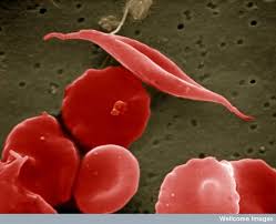 Image result for Anemia angolensis