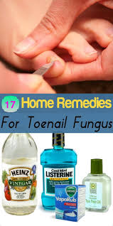 17 Home Remedies For Toenail Fungus Homeremedies For Toenail Fungus Healthremedies Health And Toenail Fungus Remedies Toenail Fungus Cure Toenail Fungus
