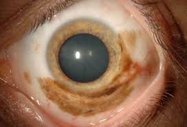Image result for conjunctival melanoma