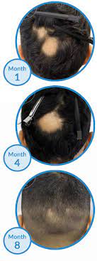 When hair follicles become damaged, the normal cycle of hair growth is disrupted, which eventually leads to hair loss. Health Issues People With Alopecia Areata May Be More Prone To
