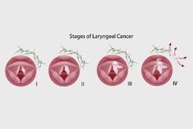 Not all nodules are cancerous in nature. Throat Cancer Types Causes Symptoms Diagnosis And Treatments