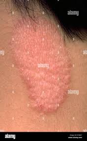 Image result for Lichen Simplex Chronicus