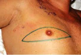 Many males with breast cancer have got it through a brca mutation, but there are other causes, including alcohol abuse and exposure to certain hormones and ionizing radiation. Male Breast Cancer Diagnosis Steemit