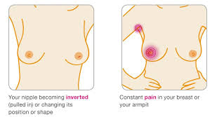 Sometimes it may be difficult to distinguish between mastitis and inflammatory breast cancer, which usually begins with redness, tenderness, and a rash, rather than a lump. 1 In 6 Breast Cancer Patients Don T Have A Lump But What Are The 6 Other Signs To Watch Out For