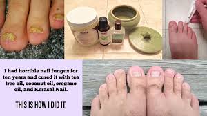 Put one drop on your nail and paint the nail with the tea tree oil, try to get some under your nail but do not pull the nail. Pin On Diet Tips