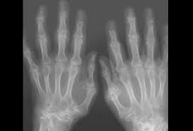 Image result for XRay Changes in Rheumatic Conditions