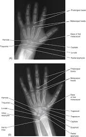 Image result for Pisiform Bone