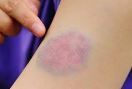 Patients were excluded if they appeared unwell, were febrile or have a history of fever, or had eccyhmoses on presentation. Bruises Causes Colors And Treatments