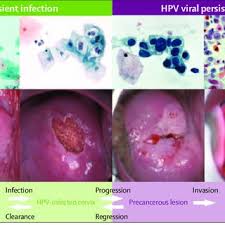 Types of hpv which cause cervical cancer are like all cancers, cancer of the cervix is much more likely to be cured if it is detected early and treated immediately. Pdf Human Papillomavirus And Cervical Cancer