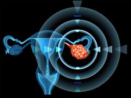 Tumor markers are chemicals made by tumor cells that can be detected in your blood. What Does Ovarian Cancer Marker Test Mean