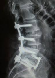 Failed Back Surgery Syndrome Treatment Options Cellular Prolotherapy Ashmore Osteopathic Groupashmore Osteopathic Group