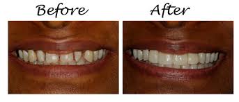 Do this without the teeth getting clogged up in wax or whatever you decide to apply. How To Fix The Gaps In Your Teeth Fix Teeth Gap Teeth Teeth Dentist