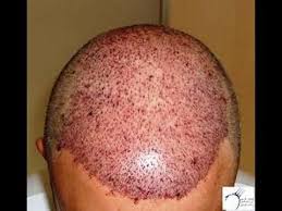 Pin On زراعة الشعر