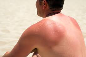 Image result for sweat rash on back