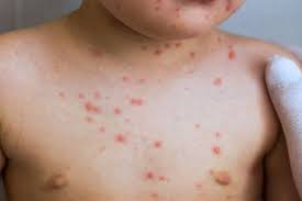 Fuoco di SantAntonio: cause, sintomi e rimedi | Semprefarmacia