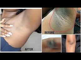 Popular targets include facial hair, leg hair, bikini area, underarm hair, back hair and chest hair. How I Removed My Armpit Hair Permanently Body Hair Removal Youtube Dark Armpits Dark Underarms Baking Soda And Lemon