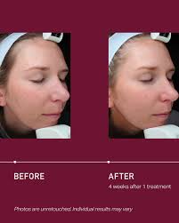 Fraxel (@FRAXEL) • Facebook