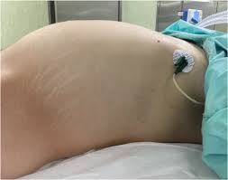 So it's vital to know why bloating happens hand how to deal with it! Giant Abdominal Cyst In A Young Female Patient A Case Report Sciencedirect