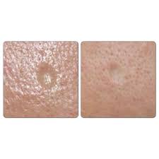 Pin On Micro Needling Collagen Induction Therapy