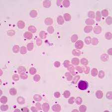 Dai primi anni duemila la piastrinopenia immune (immune thrombocytopenia, itp) è stata oggetto di crescente interesse. Piastrine Basse Cause In Gravidanza E Tumori Pazienti It
