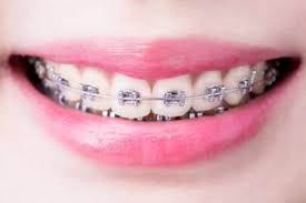 An underbite occurs when your lower front teeth stick out over your upper there are several signs you need braces. Braces And Orthodontics Nhs