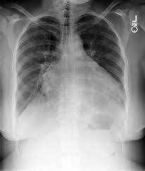 Chest X Ray Showing Moderate Cardiomegaly And Prominent Bibasilar Download Scientific Diagram