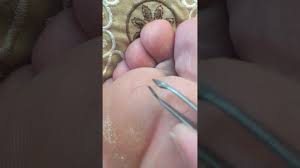 Hair Splinter In My Foot Youtube