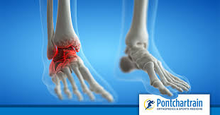 Broken ankles affect people of all ages. Broken Or Sprained Ankle Pontchartrain Orthopedics Sports Med