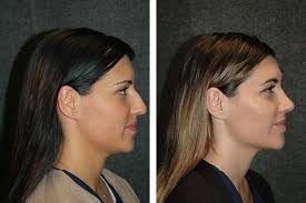 New York Rhinoplasty Specialist Dr Andrew Jacono Open Rhinoplasty Before And After Patient Rhinoplasty Rhinoplasty Before And After Rhinoplasty Nose Job