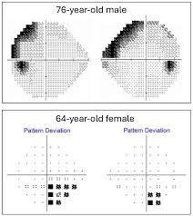 Image result for Visual Field Deficit