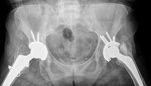 Bone cancer is a malignant tumor that arises from the cells that make up the bones of the body. Hip Pinning Johns Hopkins Medicine