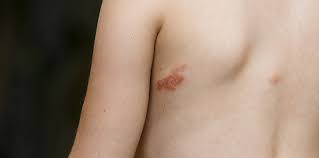 Image result for Impetigo