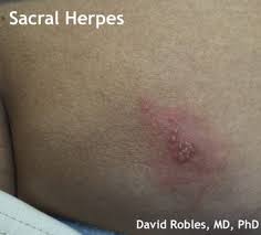 Pictures of yeast infected bumps. Candida Home Diagnosis Crack Buttock Epicuriousmorsels Com
