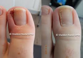 Before And After Ingrown Nails Sheldon H Nadal D P M Toronto On Podiatrist Here are 11 fall nail colors you need right now. sheldon h nadal dpm
