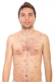 Tumefactie dureroasa umpluta cu puroi localizata sub piele (abces cutanat). Alergii Cutanate