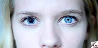 anizokori goz hastaligi optisyenin sesi