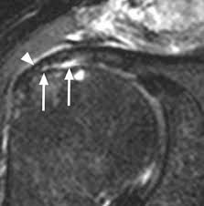 Partial Rotator Cuff Tears Radsource
