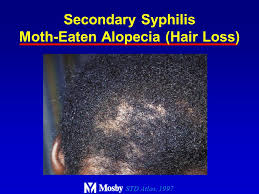 If the bacteria that cause syphilis get into your central nervous system, you can develop a condition called neurosyphilis. Syphilis Clinical Aspects Epidemiology And Control Ppt Video Online Download