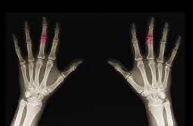 Degenerative Bone Disease And Workers Compensation Benefits