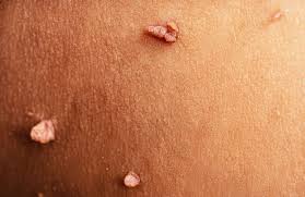 16 Natural Home Remedies for Warts and When to Seek Help from Urgent Care  in Bridgeport,