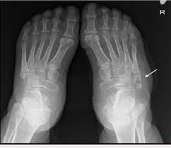 Image result for Foot XRay