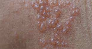 Image result for herpes zoster