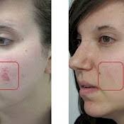 Although most frequently used on the face, laser skin resurfacing can be used with more conservative treatment parameters to address photodamage, sun spots, skin textural changes, and wrinkles on the chest. Fractional Co2 Laser Treatments Nyc Schweiger Dermatology