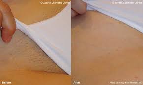 In charlotte and huntersville, nc, as well as the surrounding areas, dr. Laser Hair Removal Nottingham Zenith Cosmetic Clinics