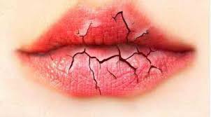Check spelling or type a new query. Bibir Pecah Pecah Punca Dan Rawatan