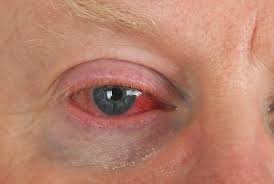 Infeksi infeksi pada mata sering kali menyebabkan mata perih, merah, dan berair. Mata Gatal Berair Dan Merah Waspadai Gejala Alergi