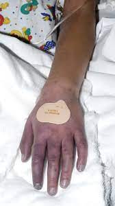 Purple Glove Syndrome Following Intravenous Phenytoin Administration Archives Of Disease In Childhood
