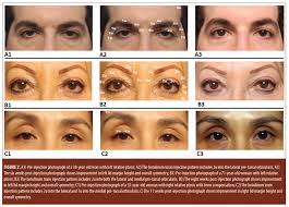 Maybe you would like to learn more about one of these? Use Of Botulinum Toxin For The Correction Of Mild Ptosis Jcad The Journal Of Clinical And Aesthetic Dermatology