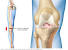 Arthritis Knee Pain Knee Support