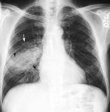 Recognizing Airspace Versus Interstitial Lung Disease Radiology Key